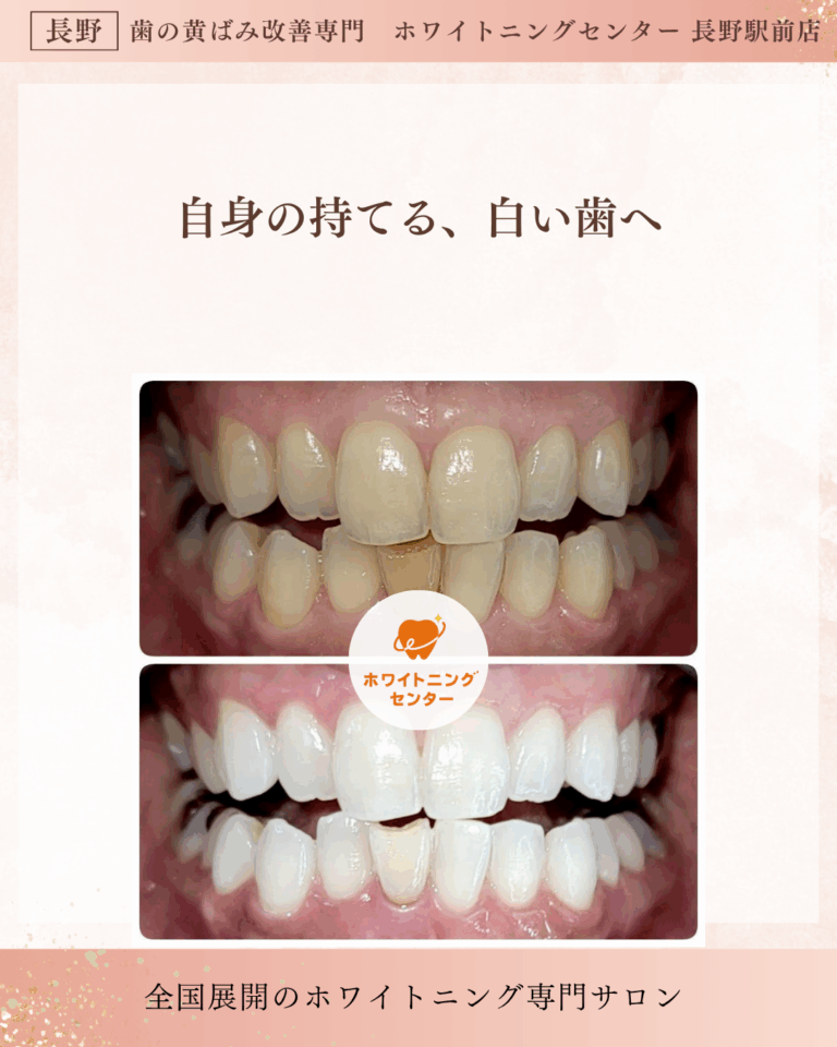 長野市にあるホワイトニングセンター 長野駅前店で医療提携ホワイトニングをして歯が白くなったお客様のビフォーアフター写真