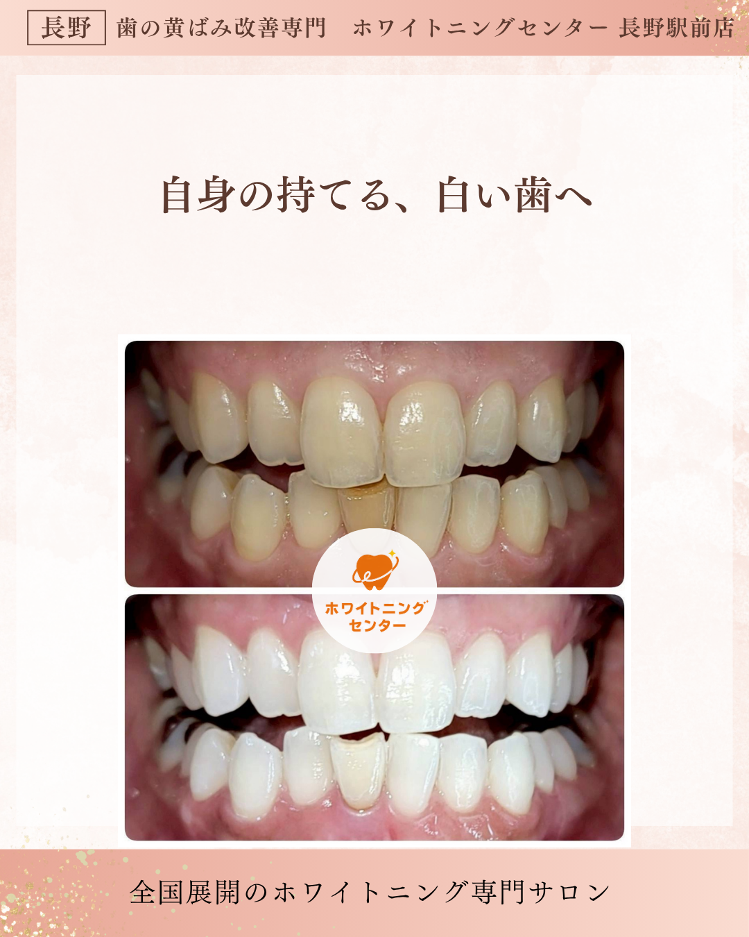 長野市にあるホワイトニングセンター 長野駅前店で医療提携ホワイトニングをして歯が白くなったお客様のビフォーアフター写真