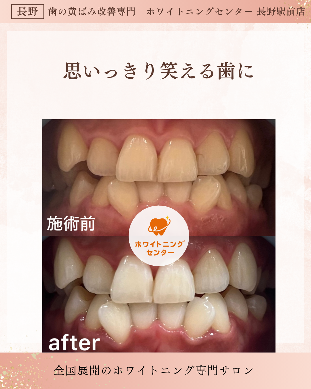 長野市にあるホワイトニングセンター長野駅前店で医療提携ホワイトニングで黄ばんだ歯から白い歯になったお客様のビフォーアフター写真