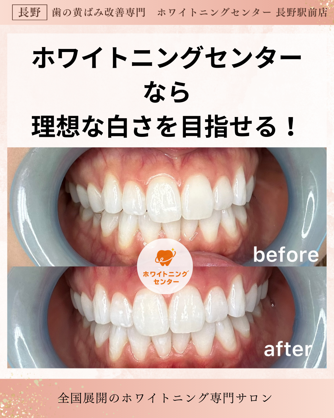 ホワイトニング施術前後の歯の色変化。長野市のホワイトニングセンター長野駅前店で初回体験により数トーン明るくなったビフォーアフター写真。