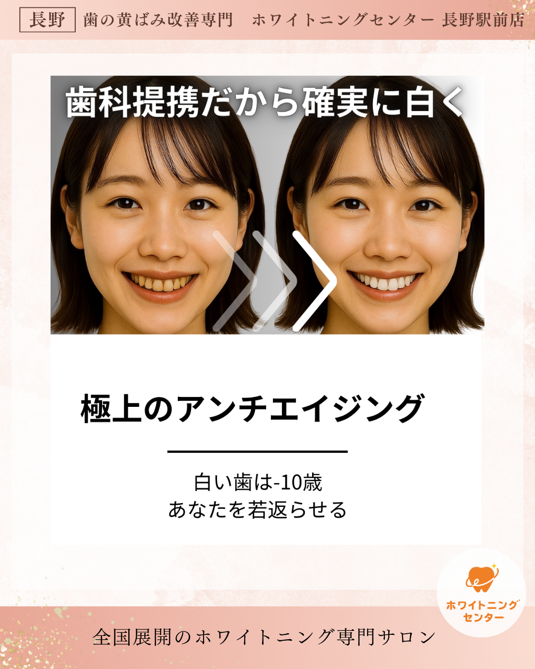 ホワイトニング施術による歯のトーンアップ事例（長野市）