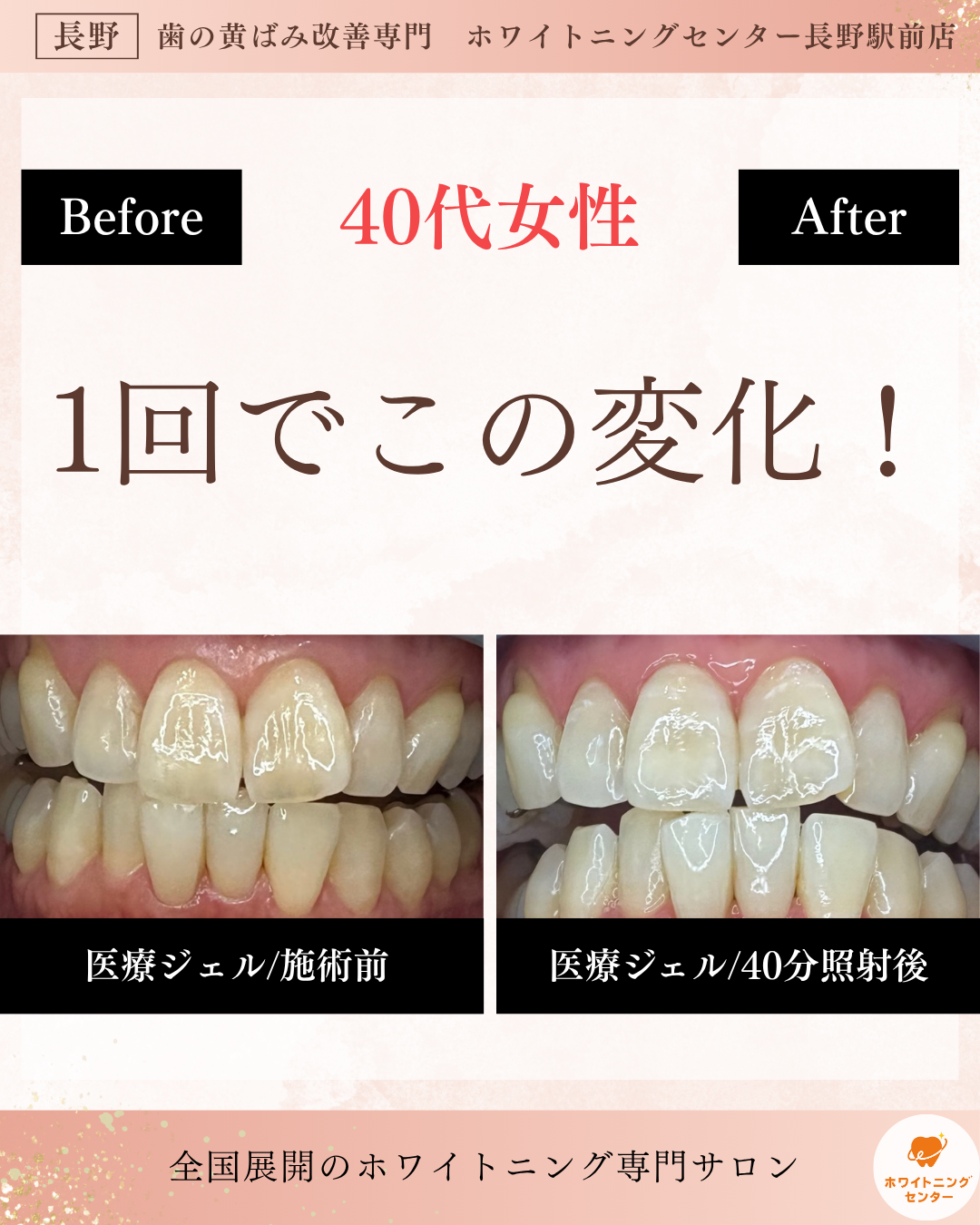 長野駅前のホワイトニングサロンで歯の黄ばみ改善を目指す女性のビフォーアフター写真。医療提携ホワイトニングの1回での効果。