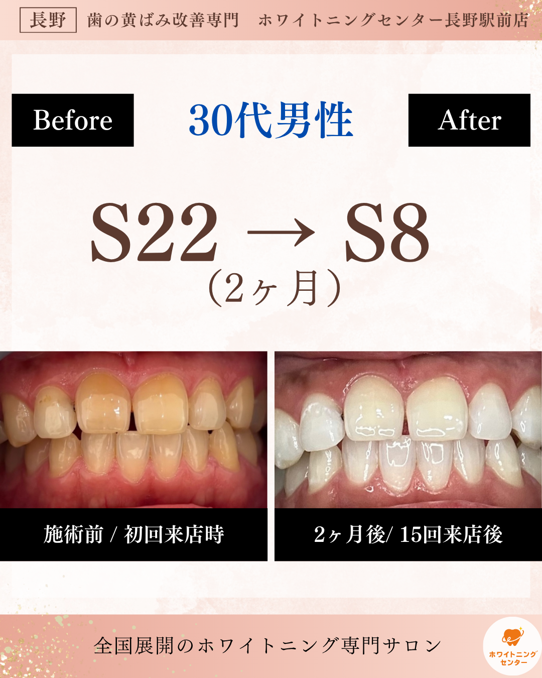 長野駅前のホワイトニングサロン・医療提携施術のビフォーアフター例