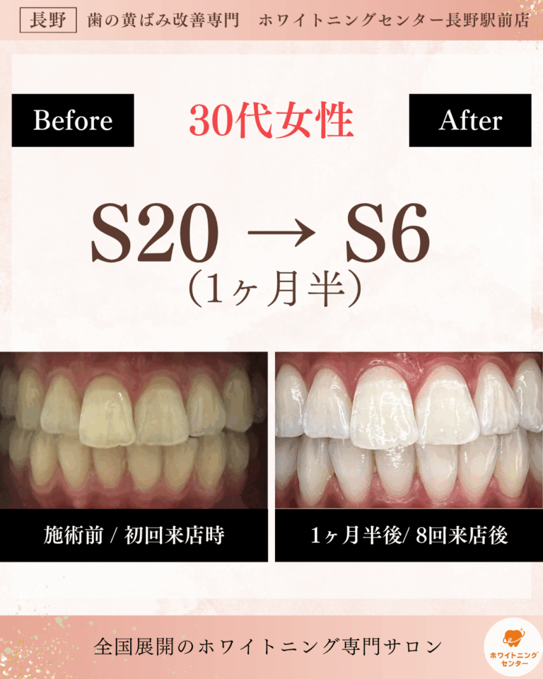 長野市のホワイトニング施術でS20からS6までトーンアップしたお客様の歯のビフォーアフター写真