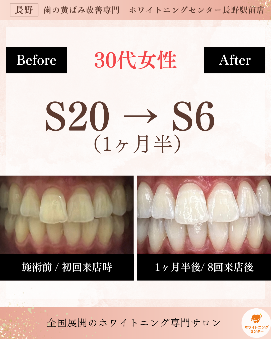 長野市のホワイトニング施術でS20からS6までトーンアップしたお客様の歯のビフォーアフター写真