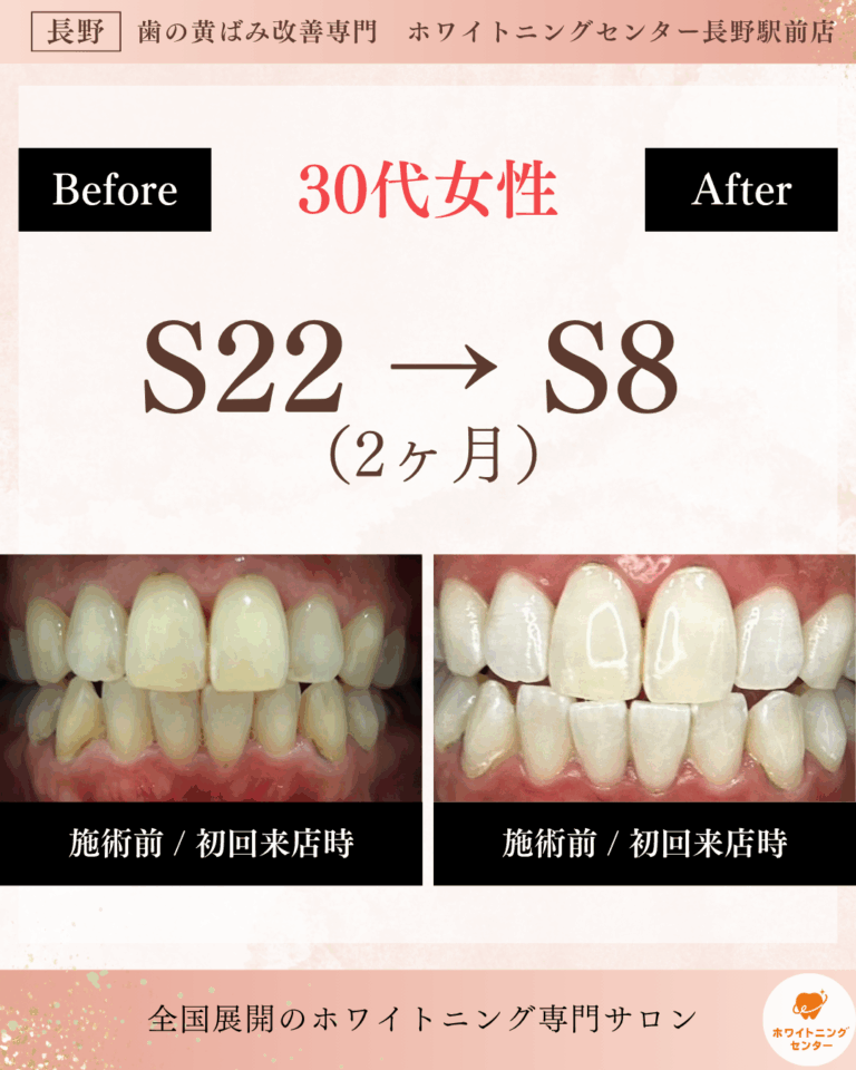 長野市のホワイトニングサロンで施術を受けた30代女性のビフォーアフター写真。2ヶ月で歯の明るさがS22からS8にトーンアップし、自然な白い歯を実現。ホワイトニングセンター長野駅前店の医療提携ホワイトニング事例。