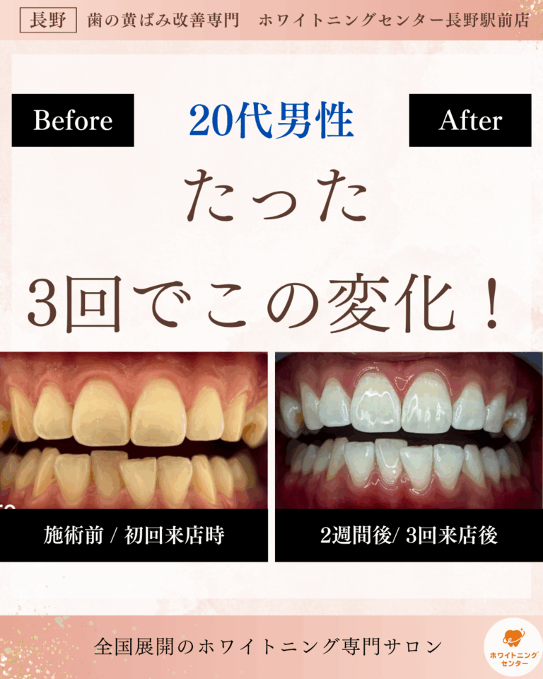 長野駅前でホワイトニング施術を受ける男性営業職のビフォーアフター写真