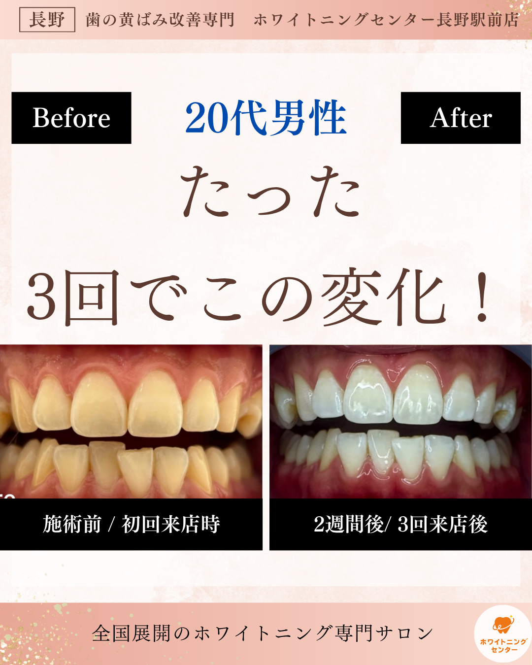 長野駅前でホワイトニング施術を受ける男性営業職のビフォーアフター写真