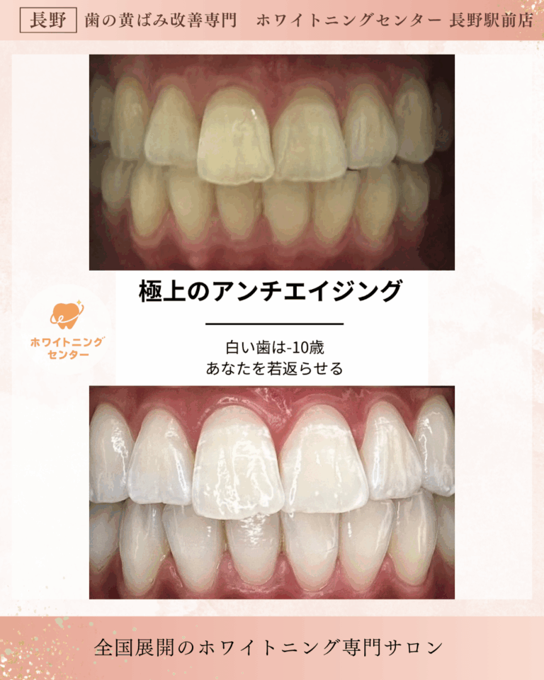 ホワイトニング施術前後の比較写真　長野市の専門サロン実例
