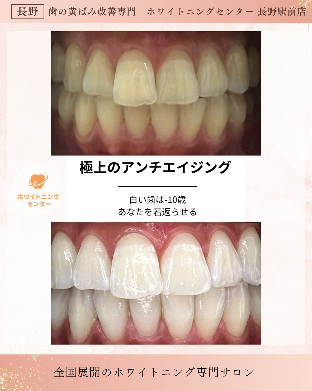 ホワイトニング施術前後の比較写真　長野市の専門サロン実例