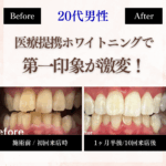 長野市にあるホワイトニングセンター長野駅前店で医療提携ホワイトニングを受け第一印象が激変した男性のビフォーアフター写真