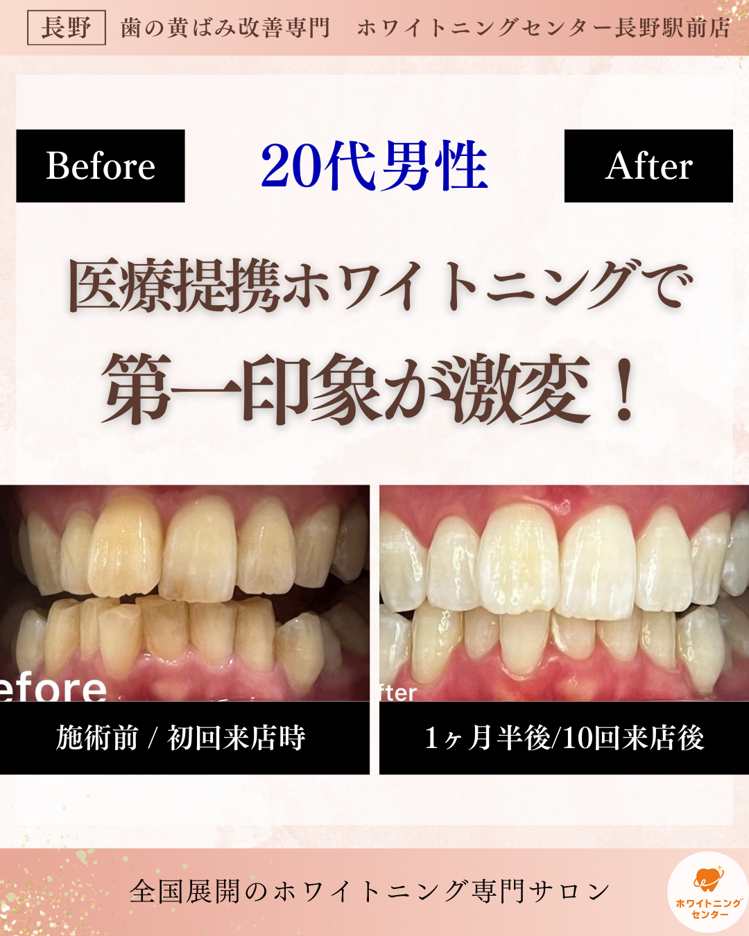 長野市にあるホワイトニングセンター長野駅前店で医療提携ホワイトニングを受け第一印象が激変した男性のビフォーアフター写真