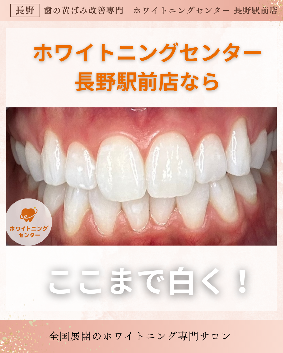 長野市のホワイトニングセンター長野駅前店で医療提携ホワイトニングを受けて、ここまで白くなった写真