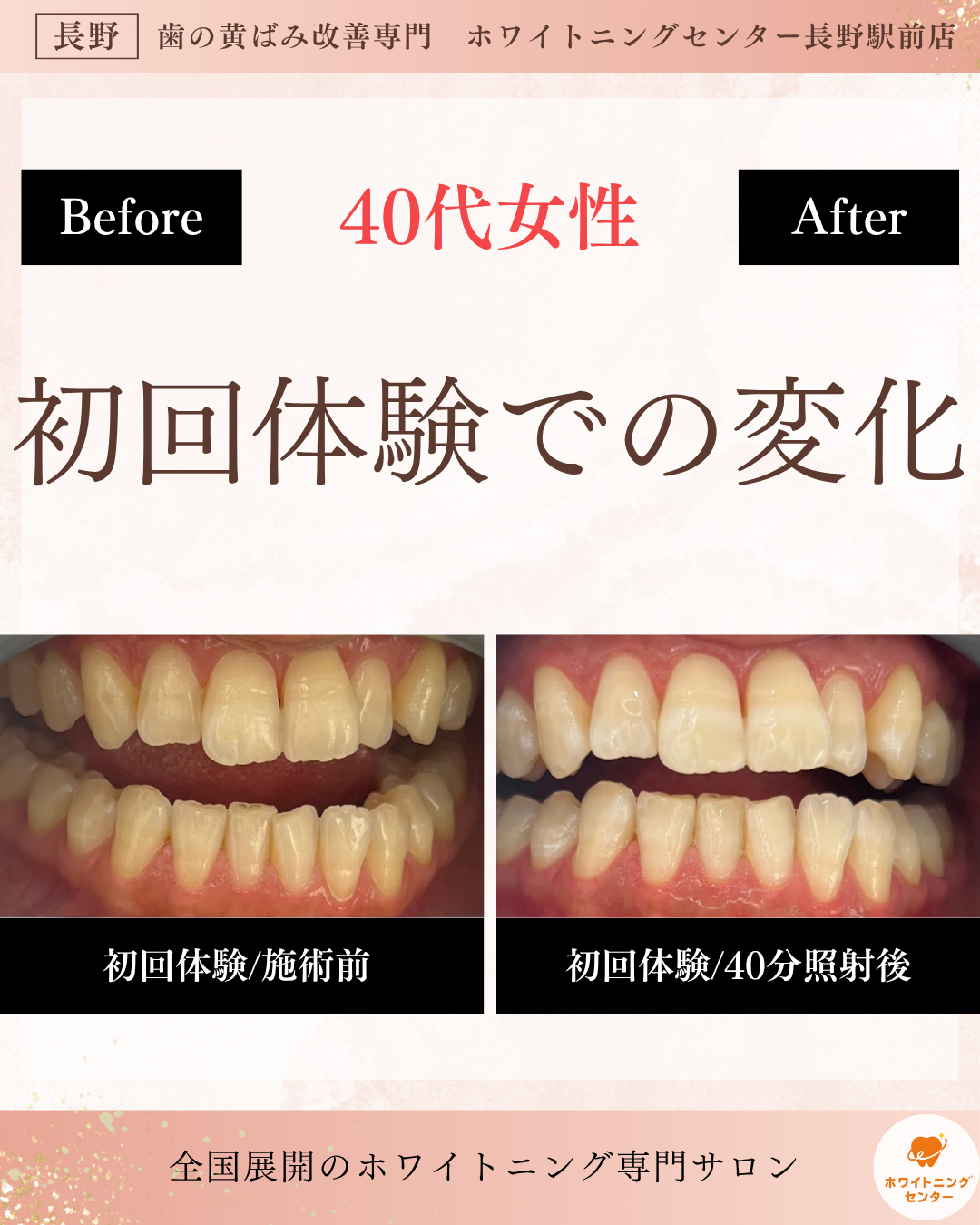 長野市のホワイトニング初回体験での歯のビフォーアフター写真。黄ばみが改善し、トーンが上がった実際の施術例