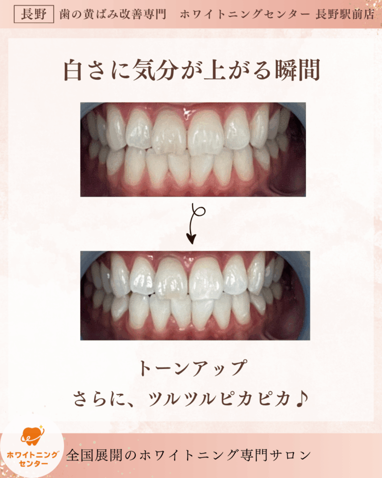 長野市の長野駅前にあるホワイトニングサロン、ホワイトニングセンター長野駅前店でホワイトニングの施術をして黄ばみを改善したお客様のビフォーアフター写真