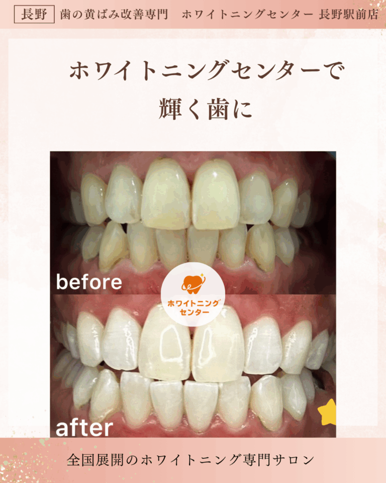 長野市のホワイトニングセンター長野駅前店でホワイトニング施術前後の歯の比較（長野駅前で白い歯を実現）