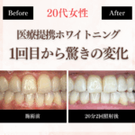 長野市にあるホワイトニングサロンのホワイトニングセンター長野駅前店で医療提携ホワイトニングの施術を受け驚きの変化が出たビフォーアフター
