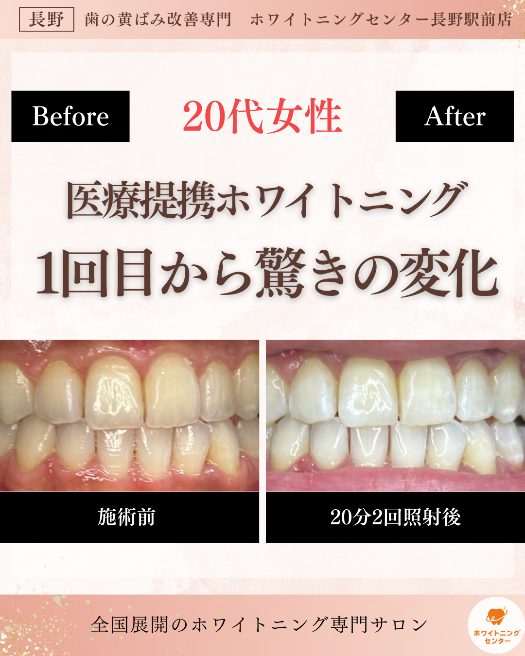 長野市にあるホワイトニングサロンのホワイトニングセンター長野駅前店で医療提携ホワイトニングの施術を受け驚きの変化が出たビフォーアフター