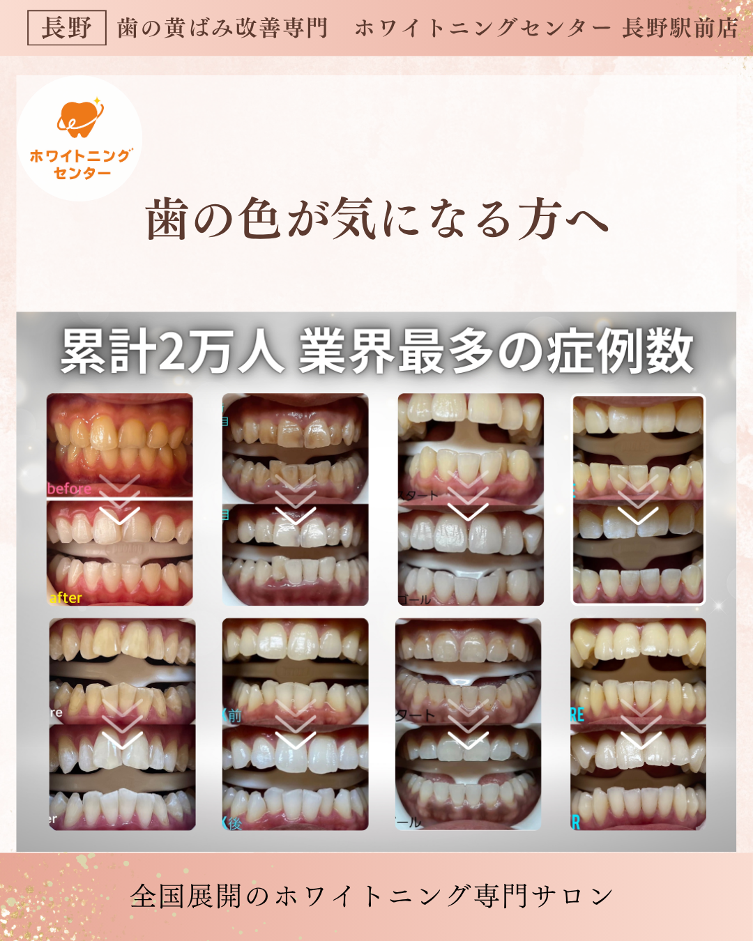長野市にあるホワイトニングセンター 長野駅前店で医療提携ホワイトニングをして歯が白くなったお客様のビフォーアフター症例写真