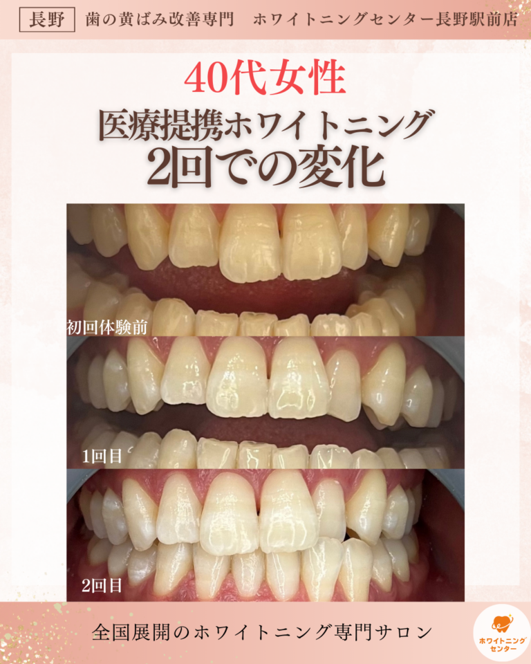 長野市にあるホワイトニングセンター長野駅前店で医療提携ホワイトニングを受けて、2回での変化の写真