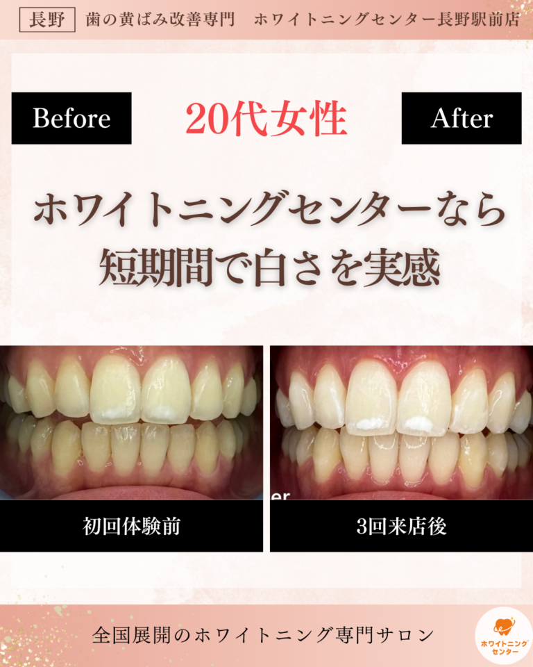 ホワイトニングセンター長野駅前店のホワイトニングなら短期間で効果を実感