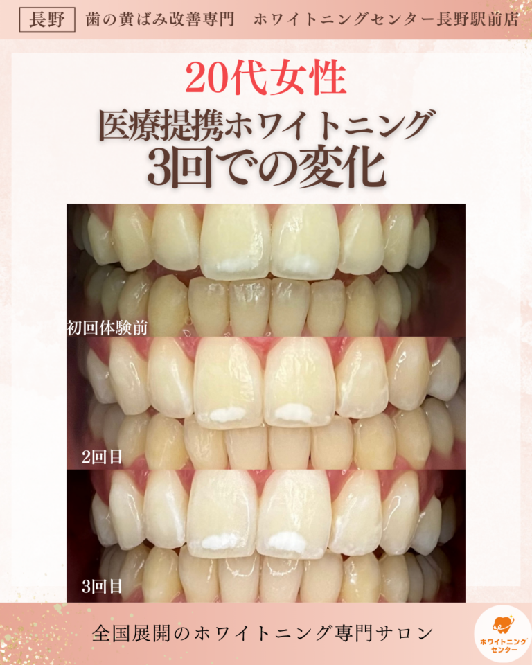 「長野市 ホワイトニング 20代女性 ビフォーアフター