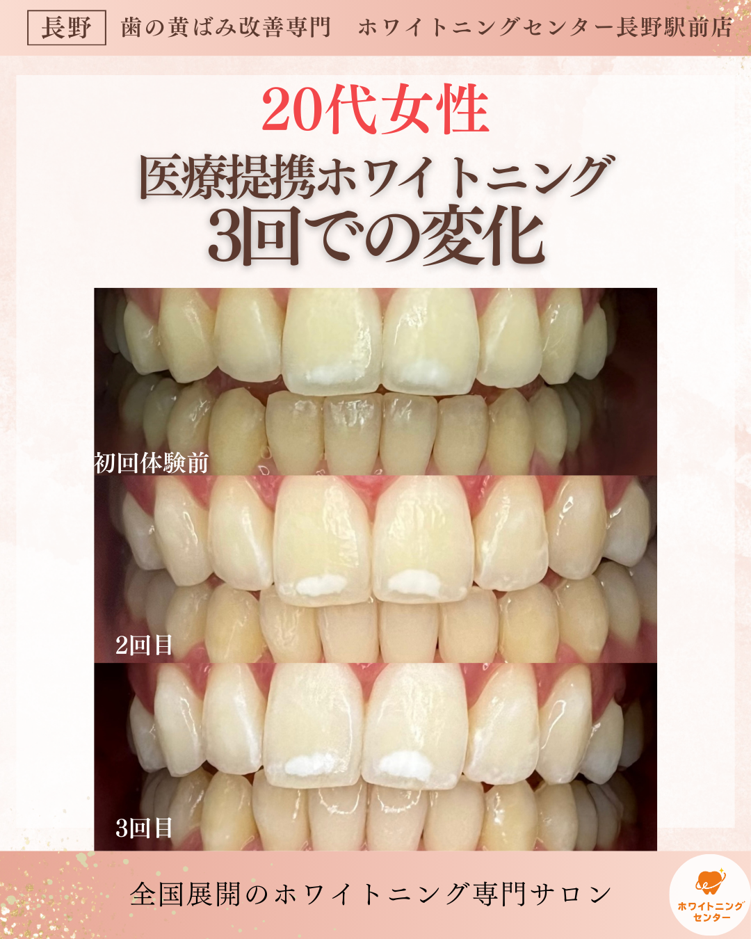「長野市 ホワイトニング 20代女性 ビフォーアフター