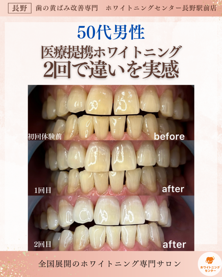 長野市のホワイトニングセンター長野駅前店でたった2回で他店との違いを実感した50代男性のビフォーアフター写真