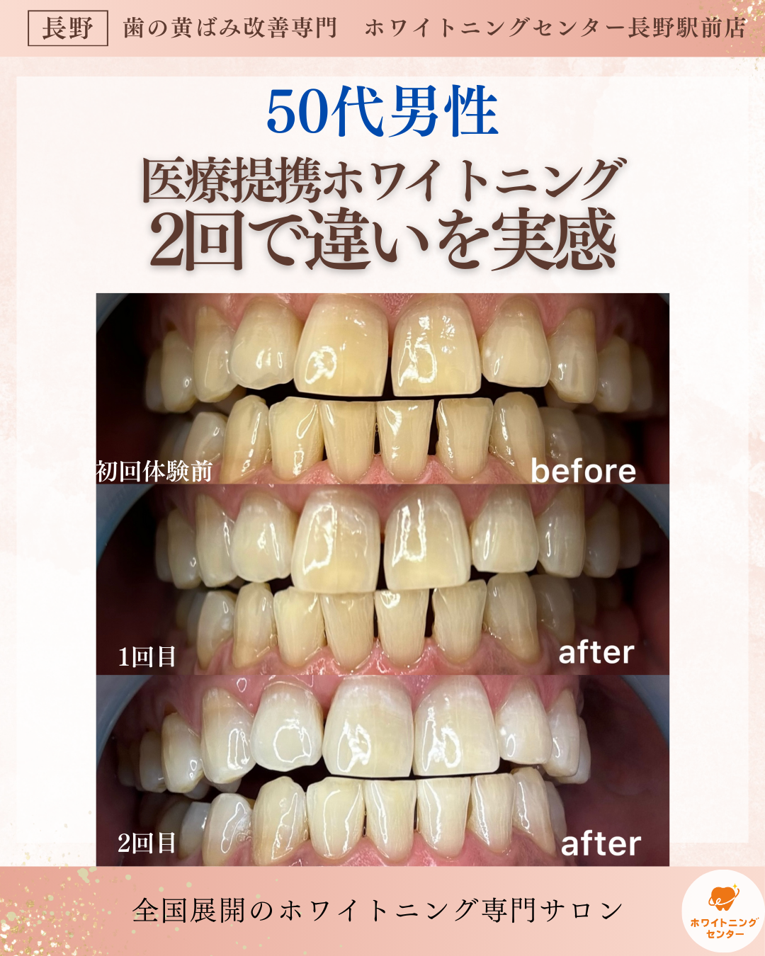 長野市のホワイトニングセンター長野駅前店でたった2回で他店との違いを実感した50代男性のビフォーアフター写真
