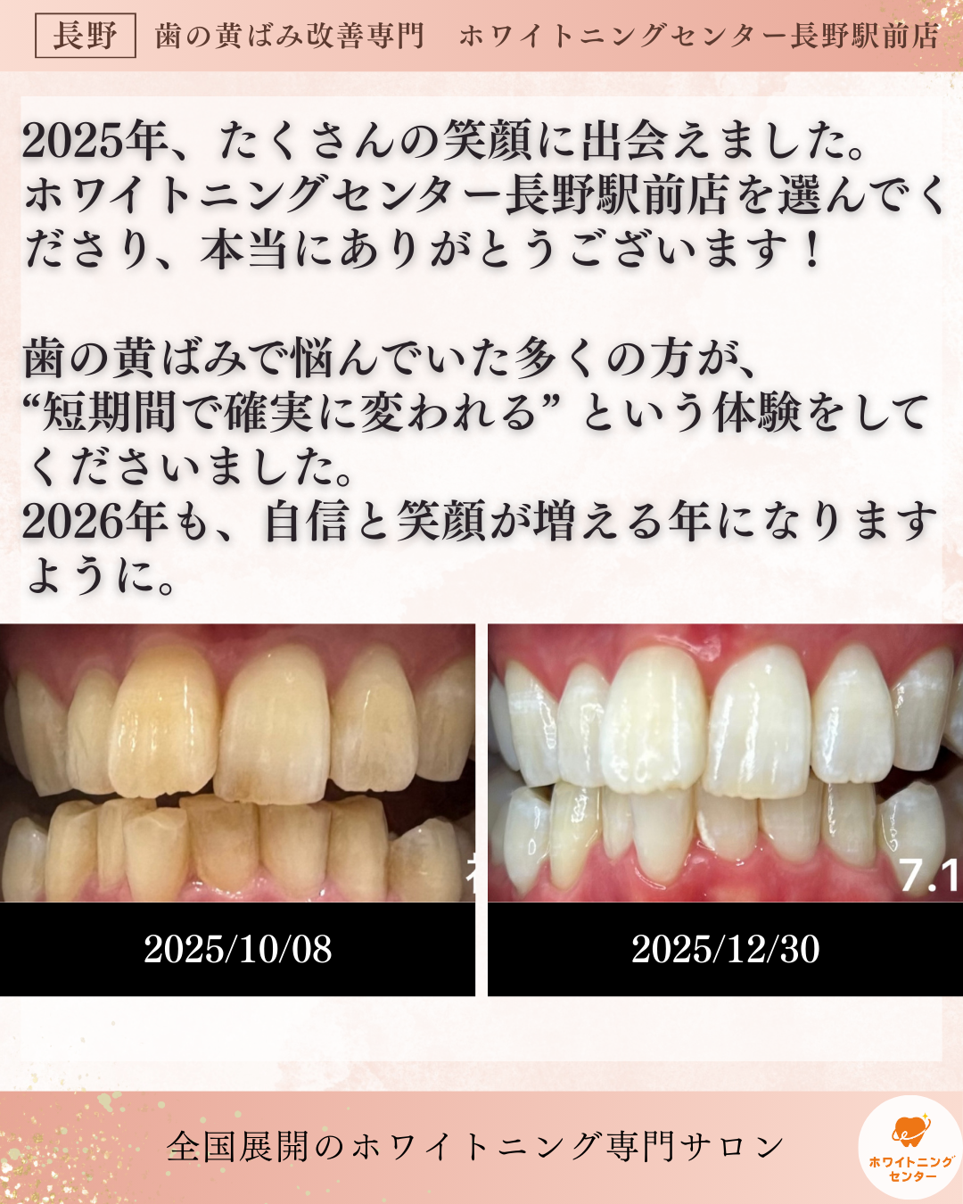 長野駅前のホワイトニングサロンによる2025年の実績。30代男性の人生を変えた約2ヶ月半での変化。短期間で歯が白くなる成功事例。
