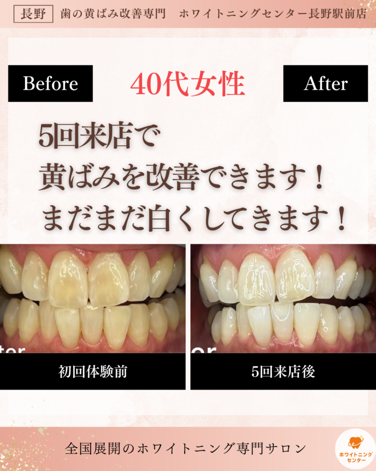 長野市_ホワイトニング_ホワイトニングセンター長野駅のホワイトニングで黄ばみ改善のビフォーアフター写真