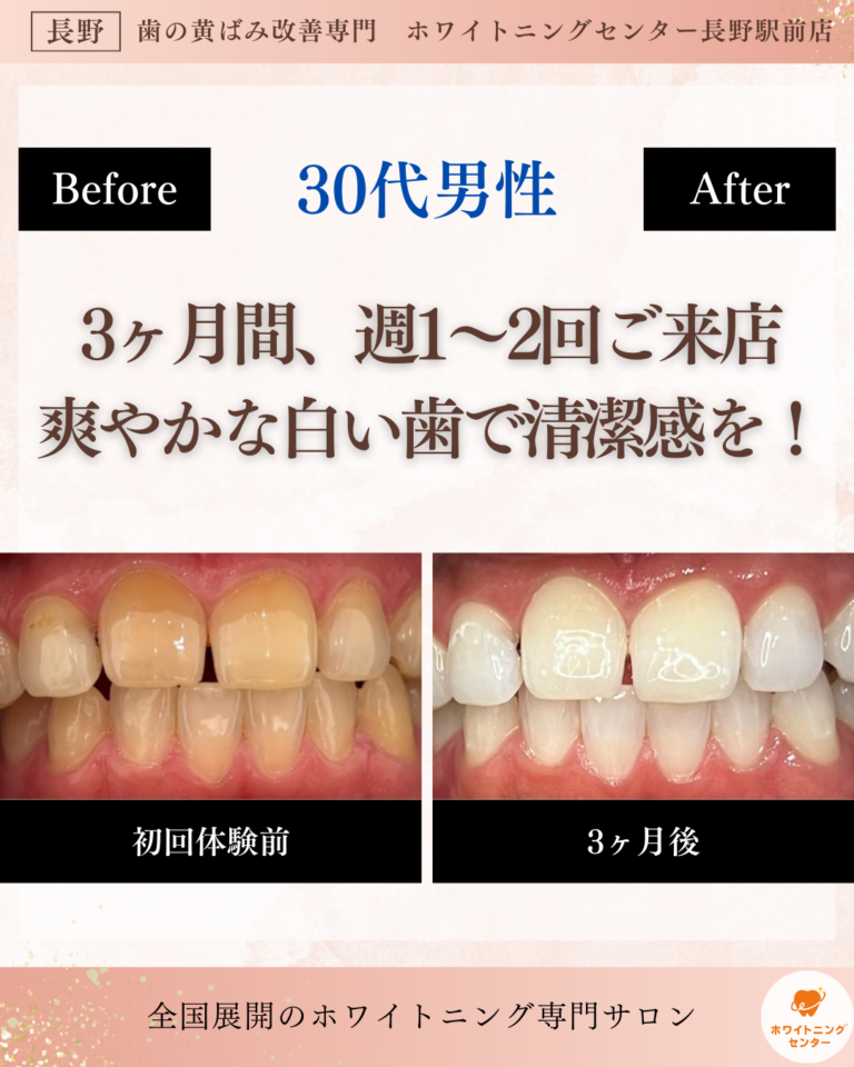 長野市_ホワイトニング_ホワイトニングセンター長野駅の医療提携で3ヶ月で清潔感を得る