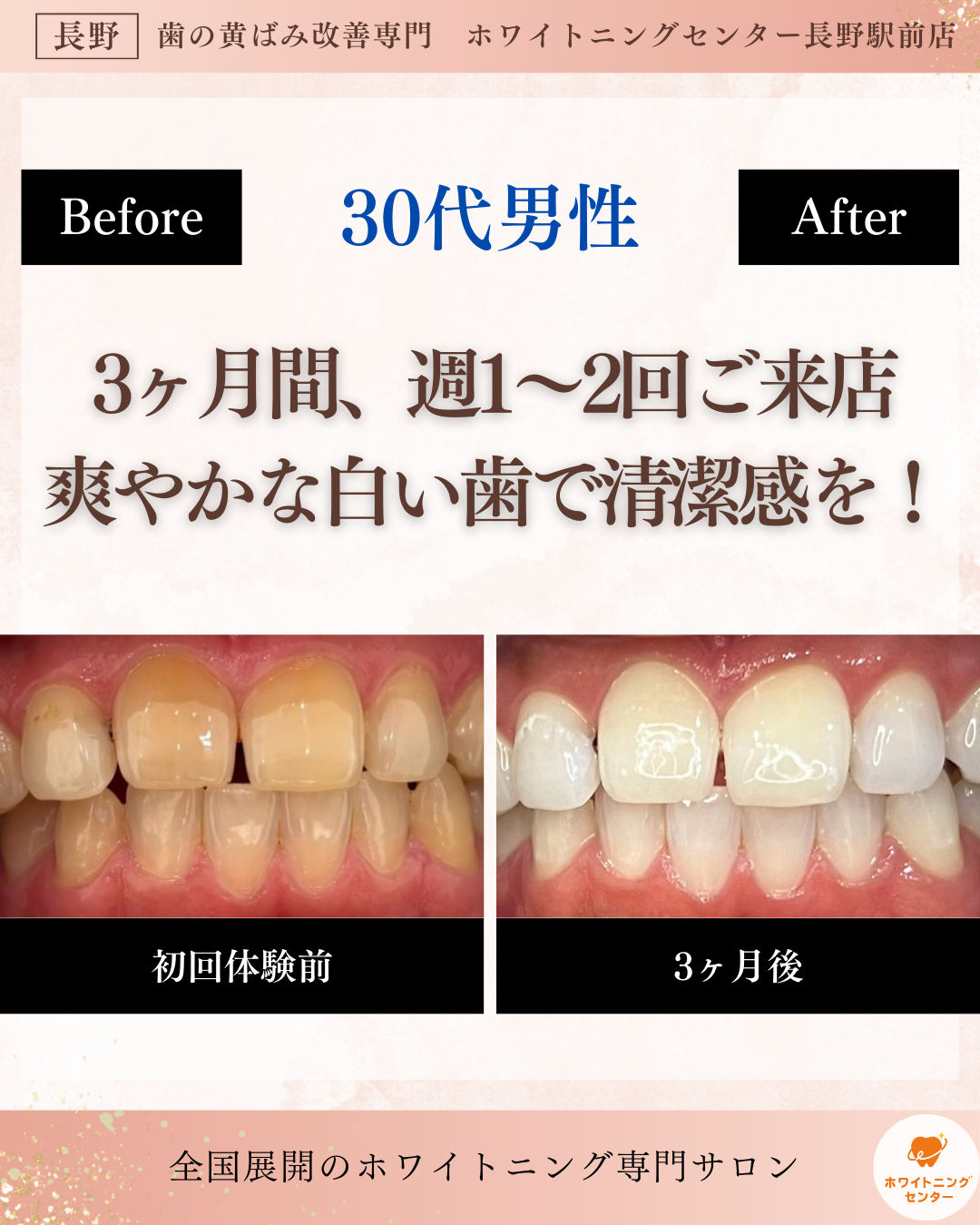 長野市_ホワイトニング_ホワイトニングセンター長野駅の医療提携で3ヶ月で清潔感を得る