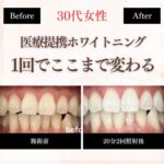長野市にあるホワイトニングセンター長野駅前店で医療提携ホワイトニングを受け1回での変化