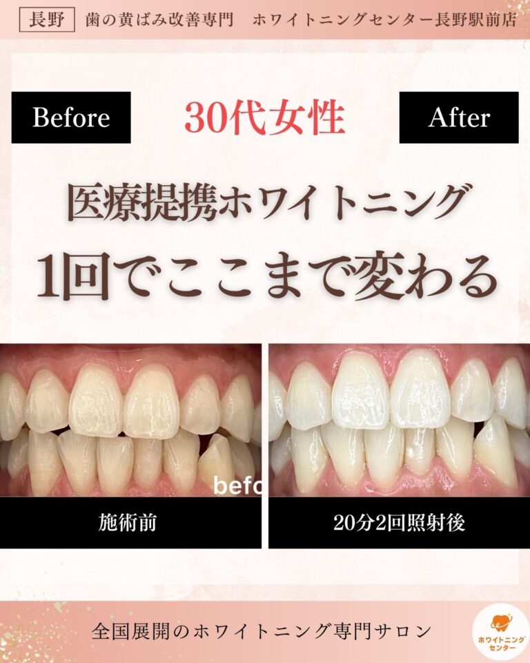 長野市にあるホワイトニングセンター長野駅前店で医療提携ホワイトニングを受け1回での変化