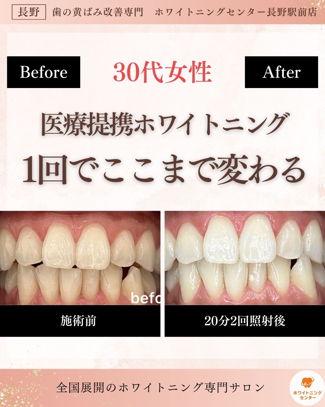 長野市にあるホワイトニングセンター長野駅前店で医療提携ホワイトニングを受け1回での変化