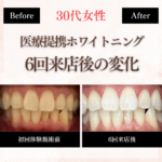 長野市にあるホワイトニングセンター長野駅前店で医療提携ホワイトニングの施術した後のビフォーアフター写真