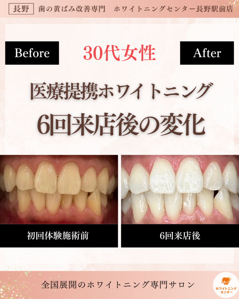 長野市にあるホワイトニングセンター長野駅前店で医療提携ホワイトニングの施術した後のビフォーアフター写真