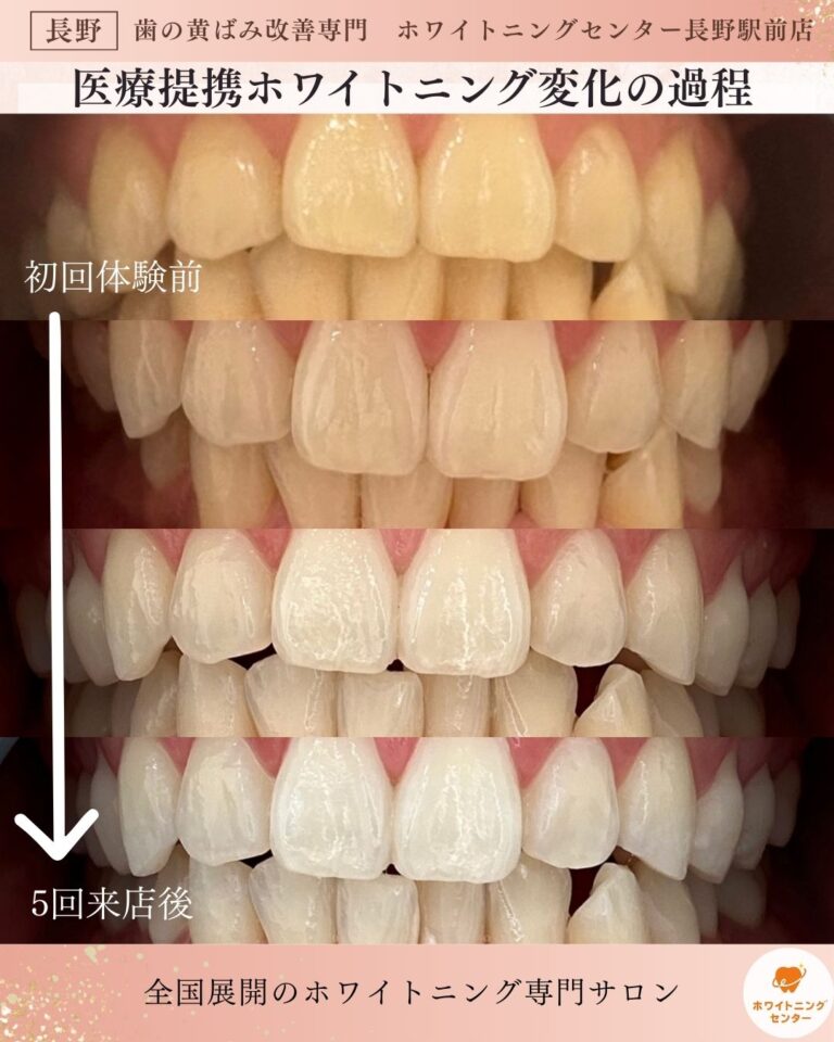 長野市_ホワイトニング_医療提携ホワイトニングの5回来店の変化の過程の写真