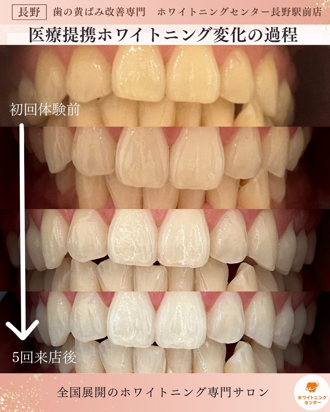 長野市_ホワイトニング_医療提携ホワイトニングの5回来店の変化の過程の写真