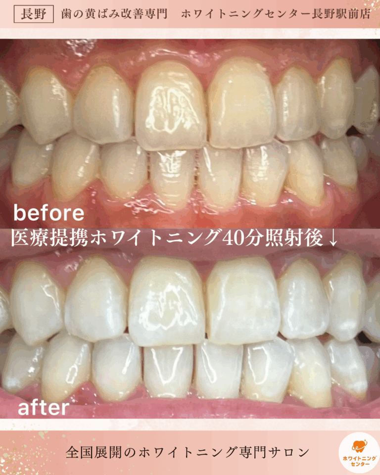 長野市_ホワイトニング_医療提携ホワイトニング施術後のビフォーアフター