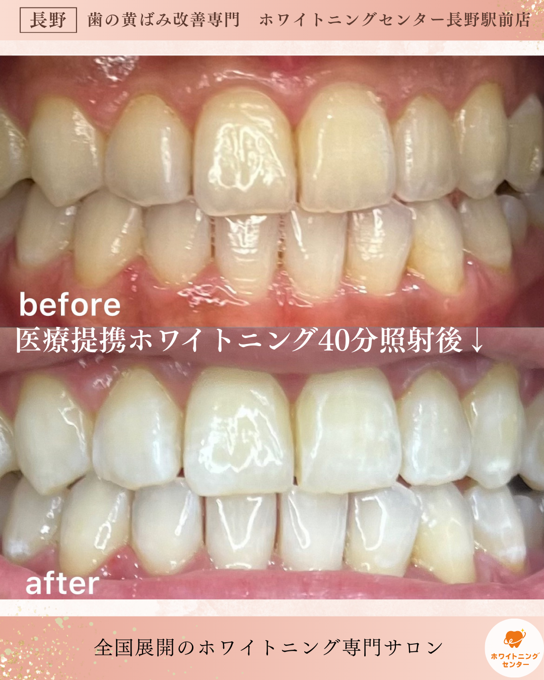 長野市_ホワイトニング_医療提携ホワイトニング施術後のビフォーアフター