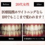 長野市にあるホワイトニングセンター長野駅前店で医療提携ホワイトニングを受け1回での変化の写真