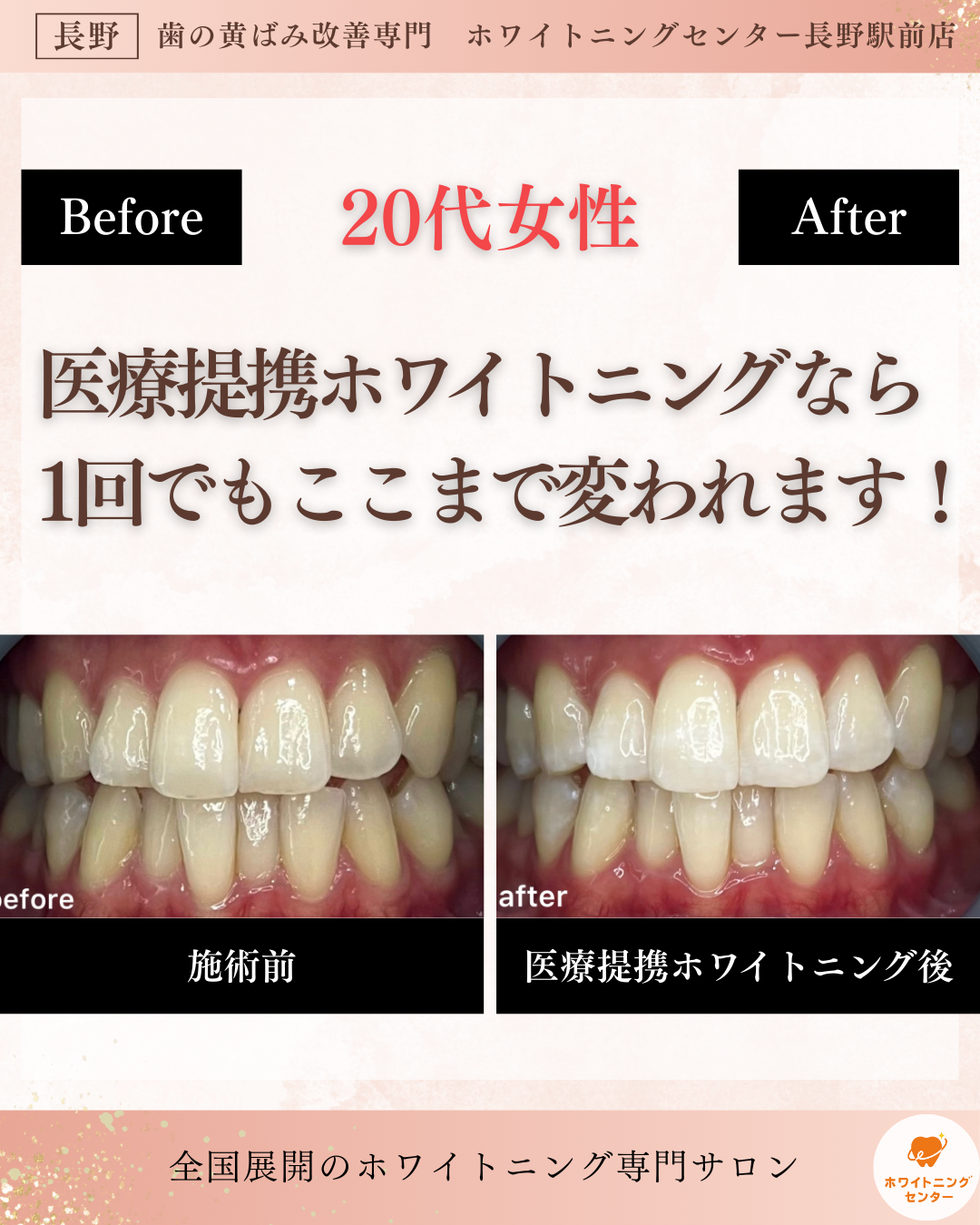長野市にあるホワイトニングセンター長野駅前店で医療提携ホワイトニングを受け1回での変化の写真