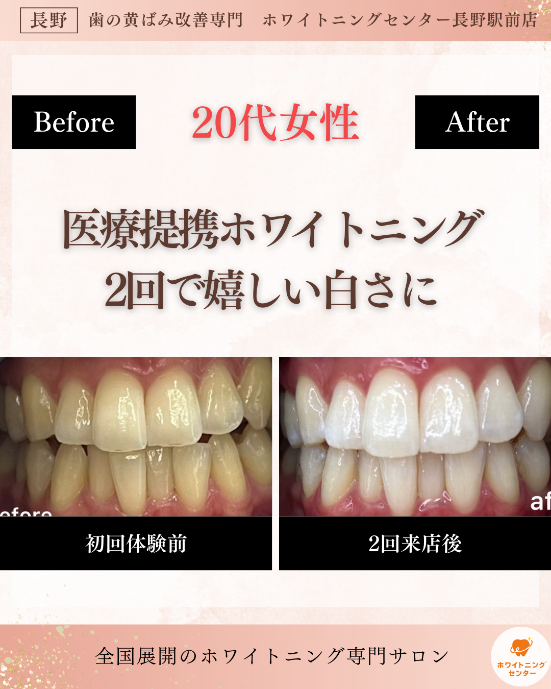 ホワイトニングセンター長野駅前店の医療提携ホワイトニングで嬉しい変化