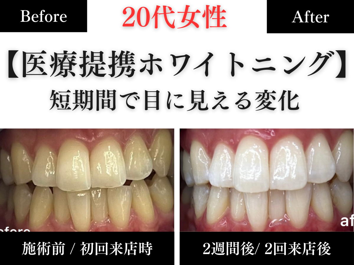 長野市のホワイトニングセンター長野駅前店で医療提携ホワイトニングを受け短期間で４効果が出た20代女性のビフォーアフター写真
