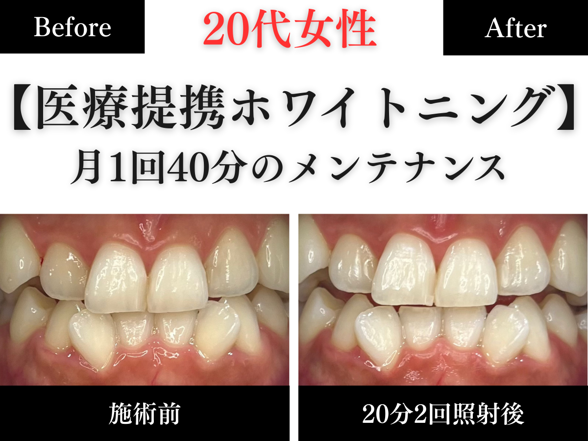 ホワイトニングセンター長野駅前店の医療提携ホワイトニングで月1回の定期的なメンテナンスで白さをキープするビフォーアフター写真
