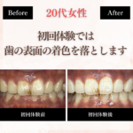長野市_ホワイトニング_ホワイトニングセンター長野駅前で初回体験のビフォーアフター