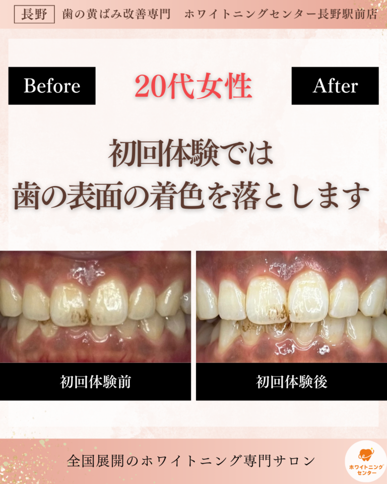 長野市_ホワイトニング_ホワイトニングセンター長野駅前で初回体験のビフォーアフター