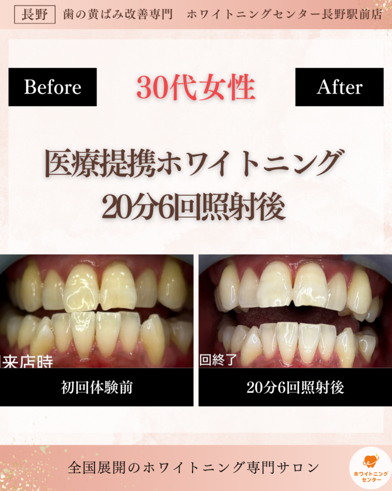 長野市_ホワイトニング_ホワイトニングセンター長野駅前で医療提携ホワイトニング6回コース